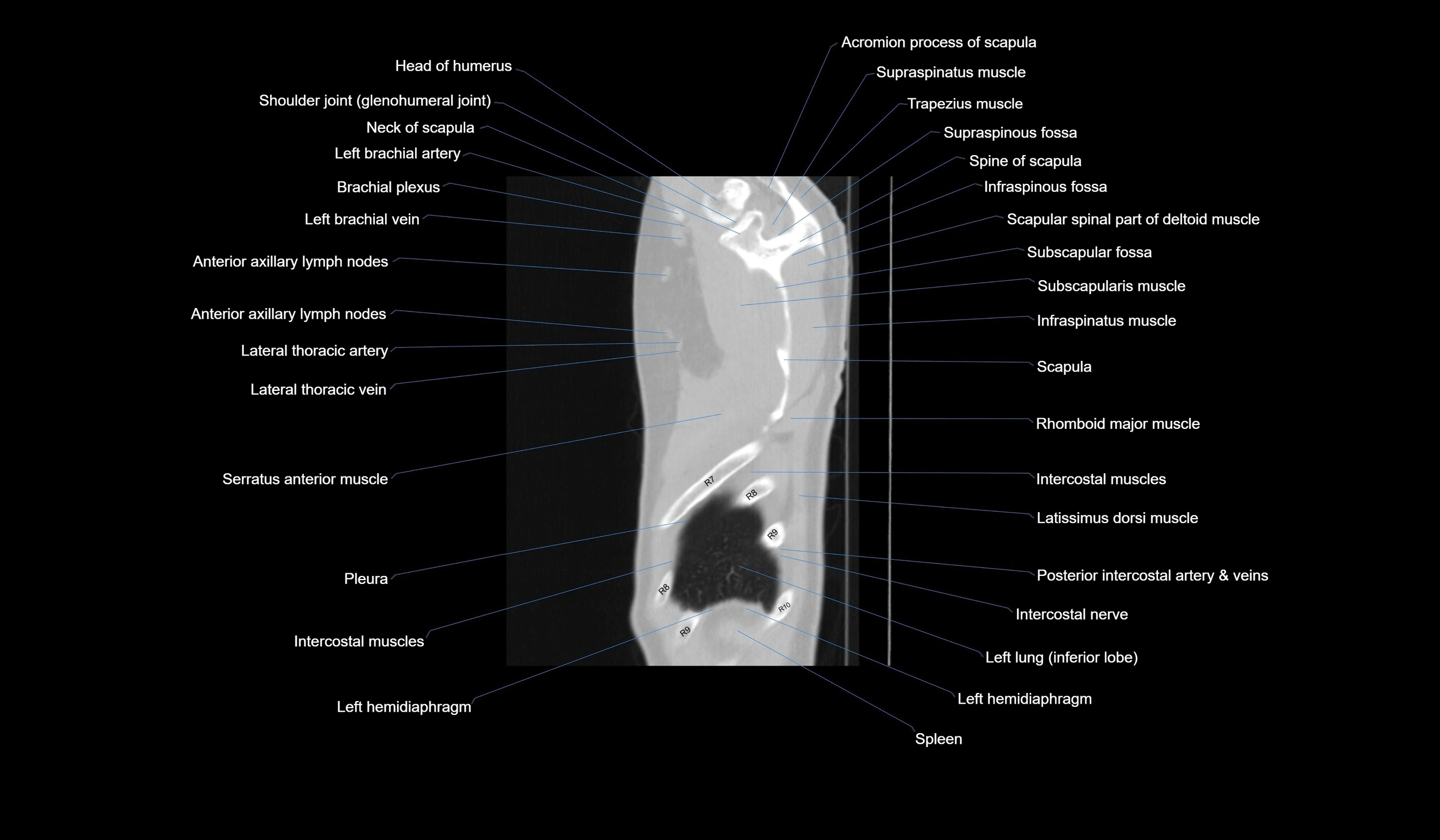 CT chest (thorax) labelled sagittal cross sectional anatomy radiology image-00132.webp